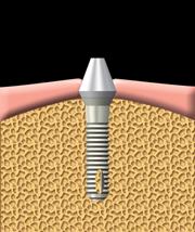 dental implants regina downtown dental dental implant in Regina