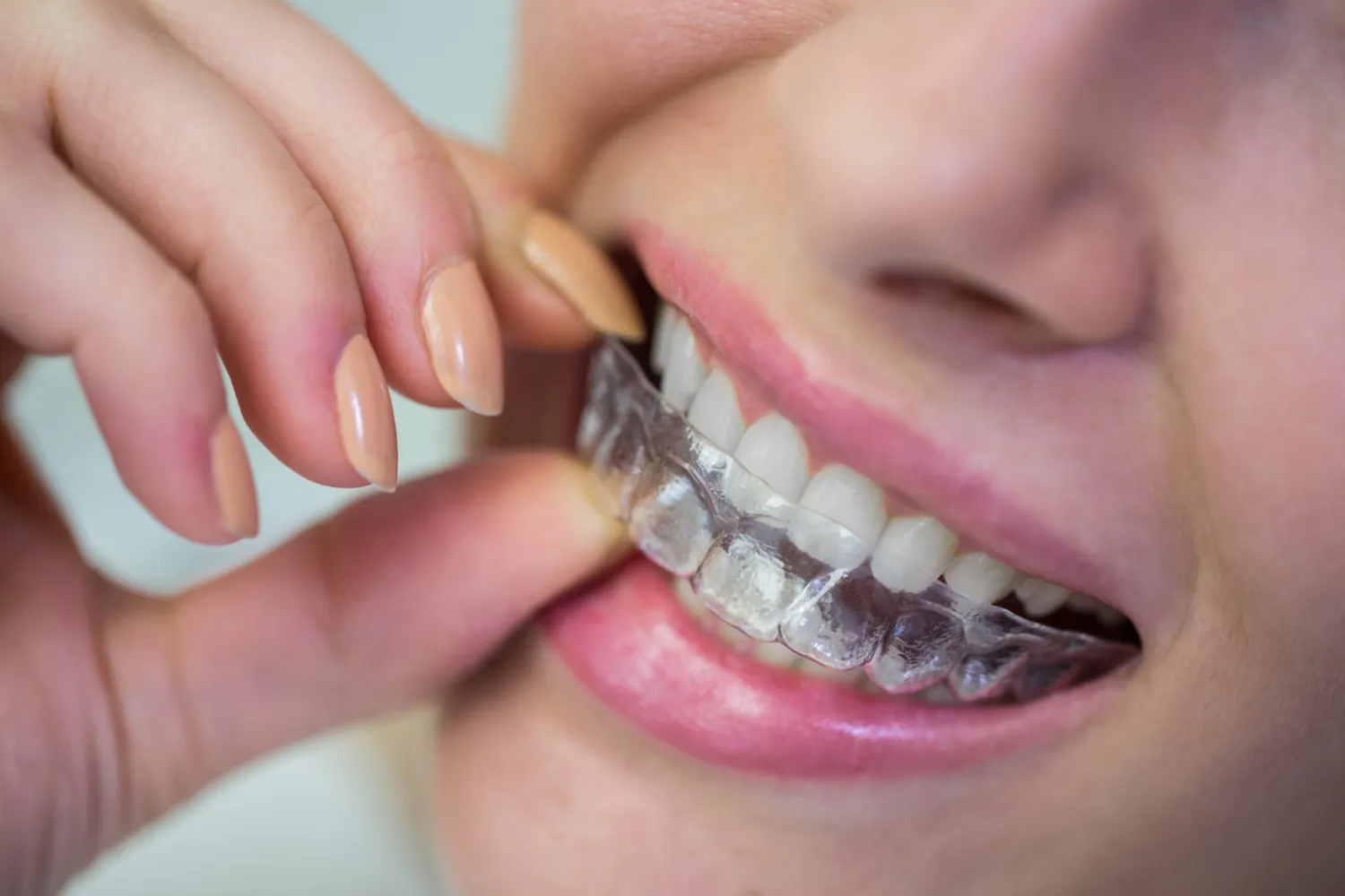 Invisalign Orthodontics Invisalign Orthodontics