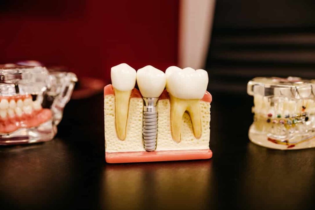 25E3BBA6 0834 48BD 8500 A568CF3F2F7E 1 105 c dental implants are a great alternative