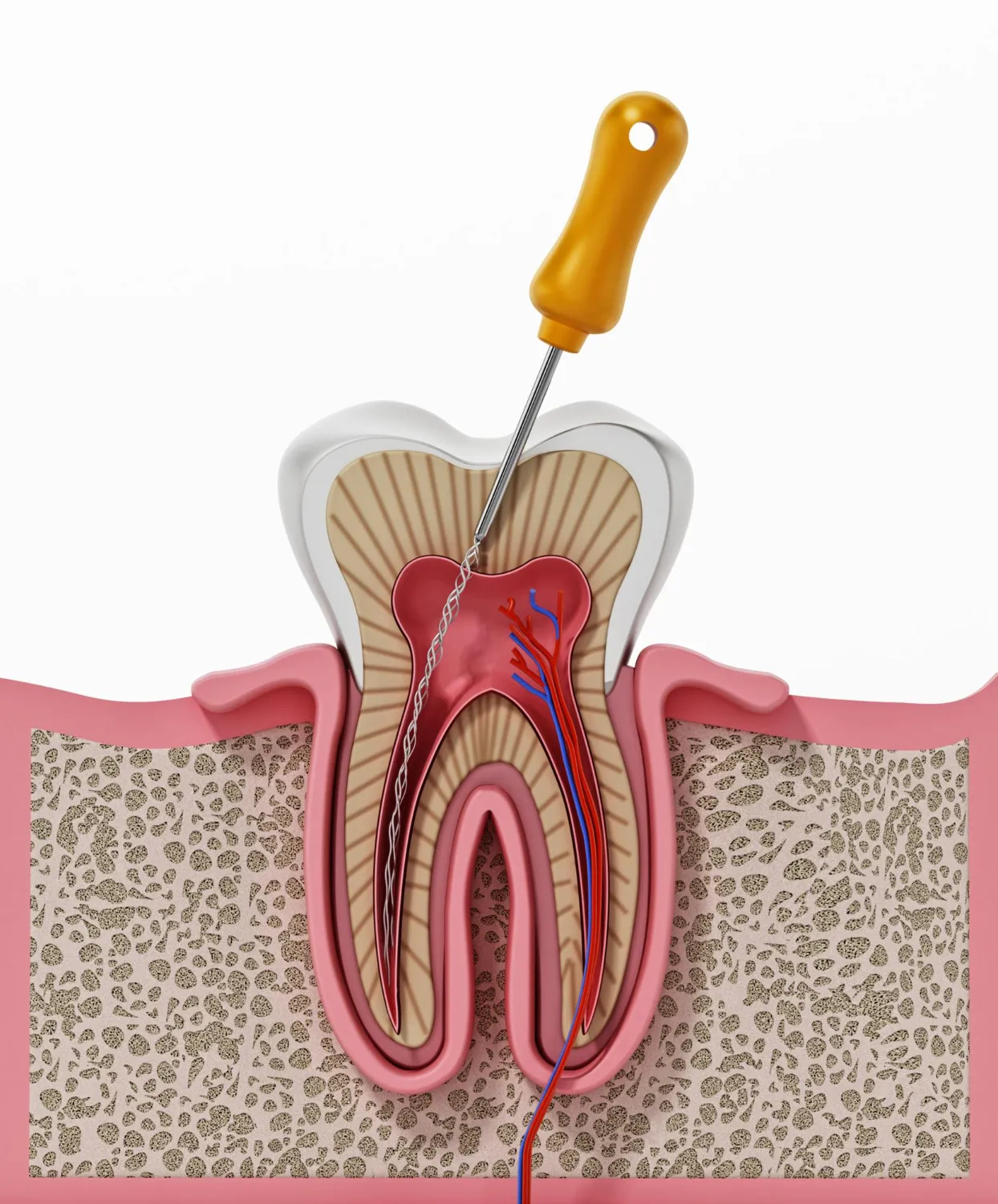 Cost Breakdown of Root Canal Treatment Cost Breakdown of Root Canal Treatment