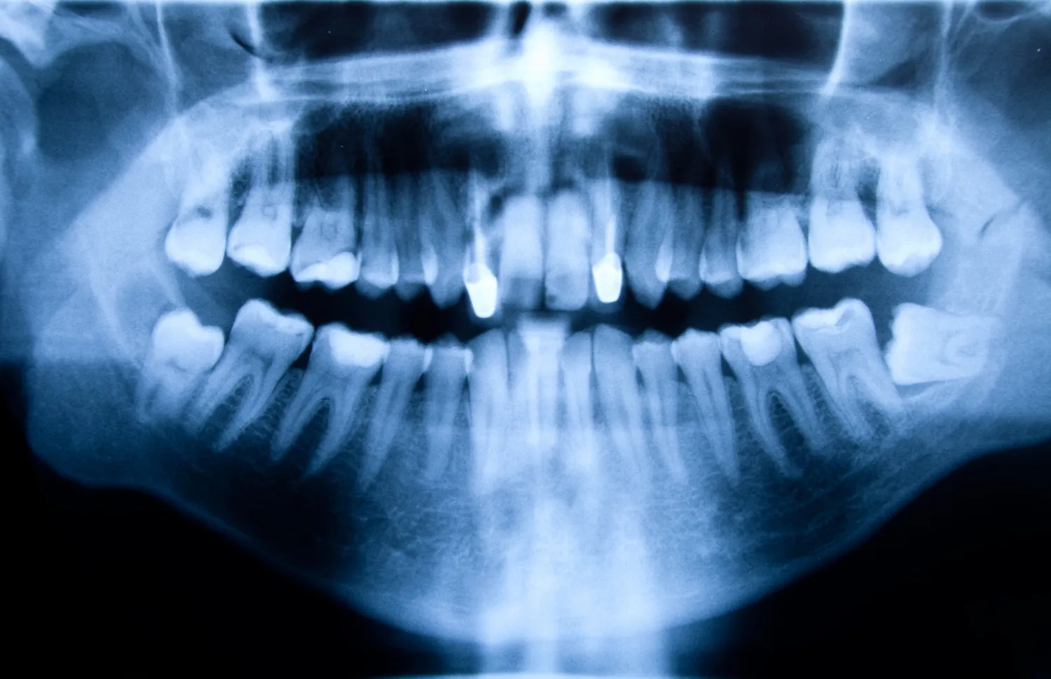 Types of Dental Oral X Rays Types of Dental Oral X-Rays
