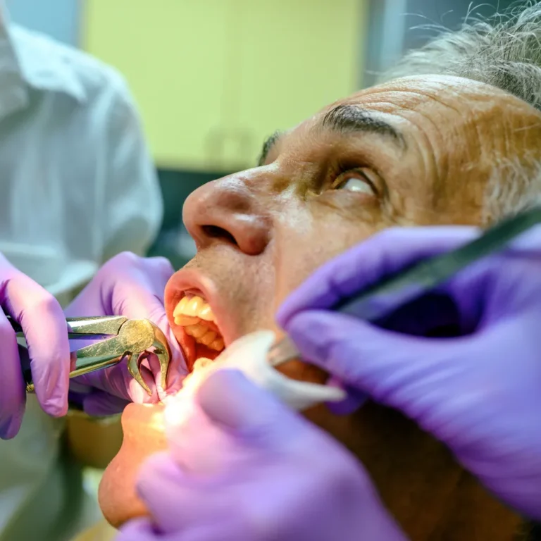 Tooth Extractions