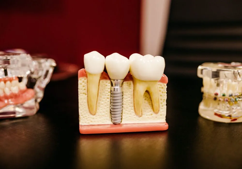 how much dental implant cost in canada how much dental implant cost in canada