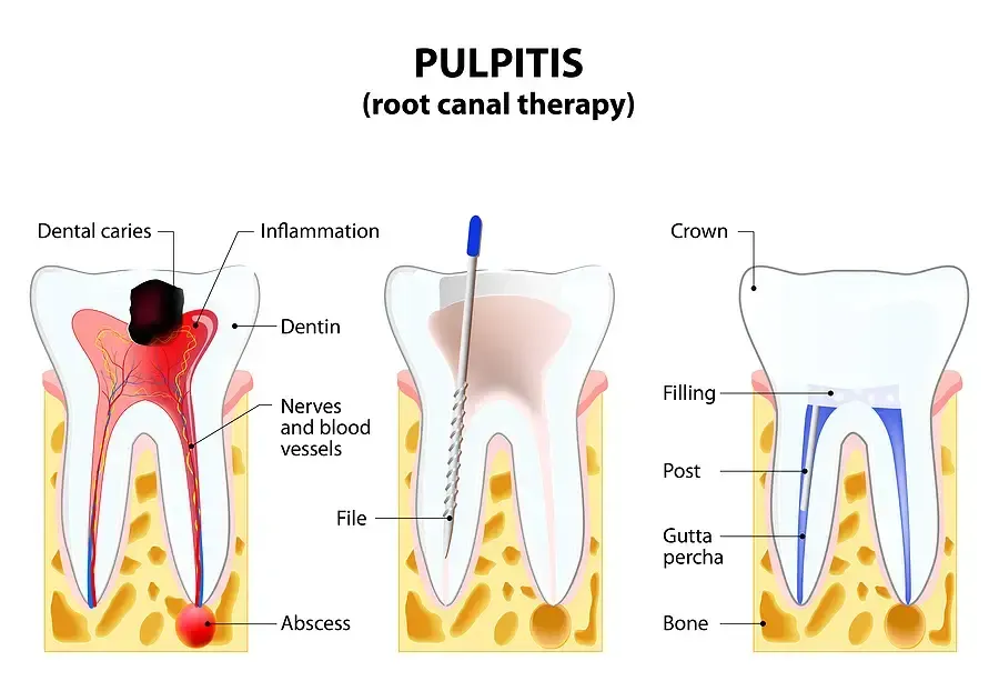 signs you might need a root canal signs you might need a root canal